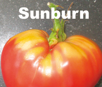 sunburn